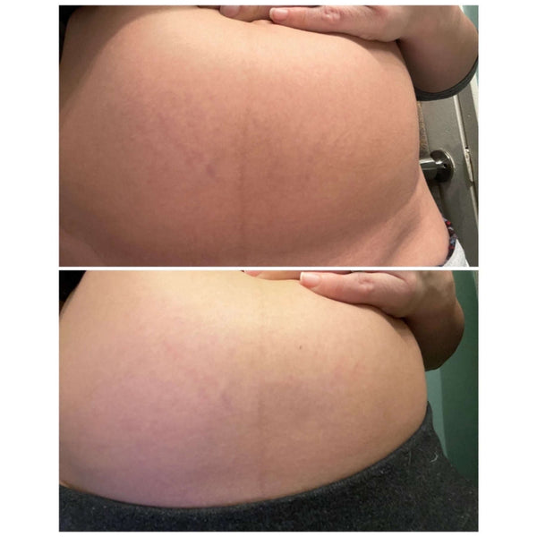 Tummy Butter for Stretch Marks